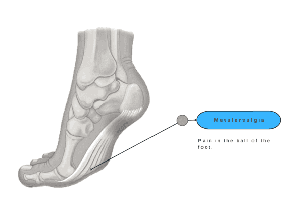 Foot Pain - Metatarsalgia | Happiest Feet