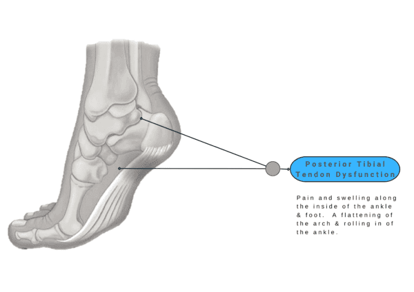 Foot Pain - Posterior Tibial Tendon Dysfunction | Happiest Feet